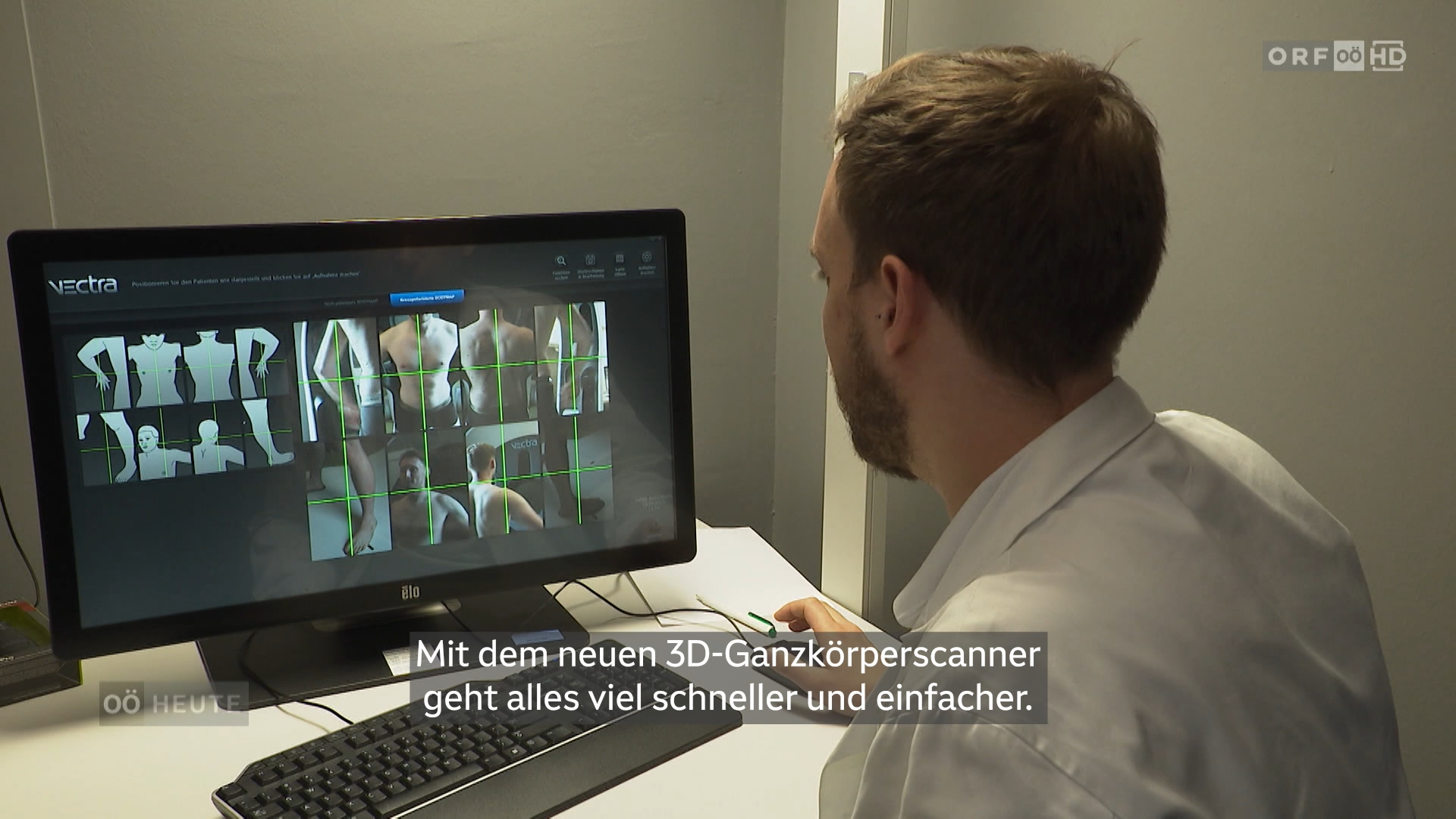 Hautkrebsfrüherkennung durch 3D-Ganzkörperscanner